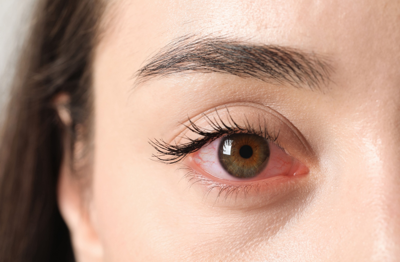 Close-up of a red, irritated eye that may indicate a potential eye emergency.