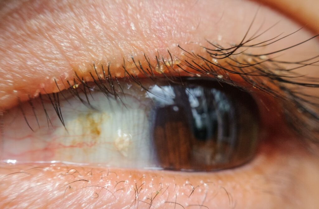 Close-up of an eye with crusty eyelids.