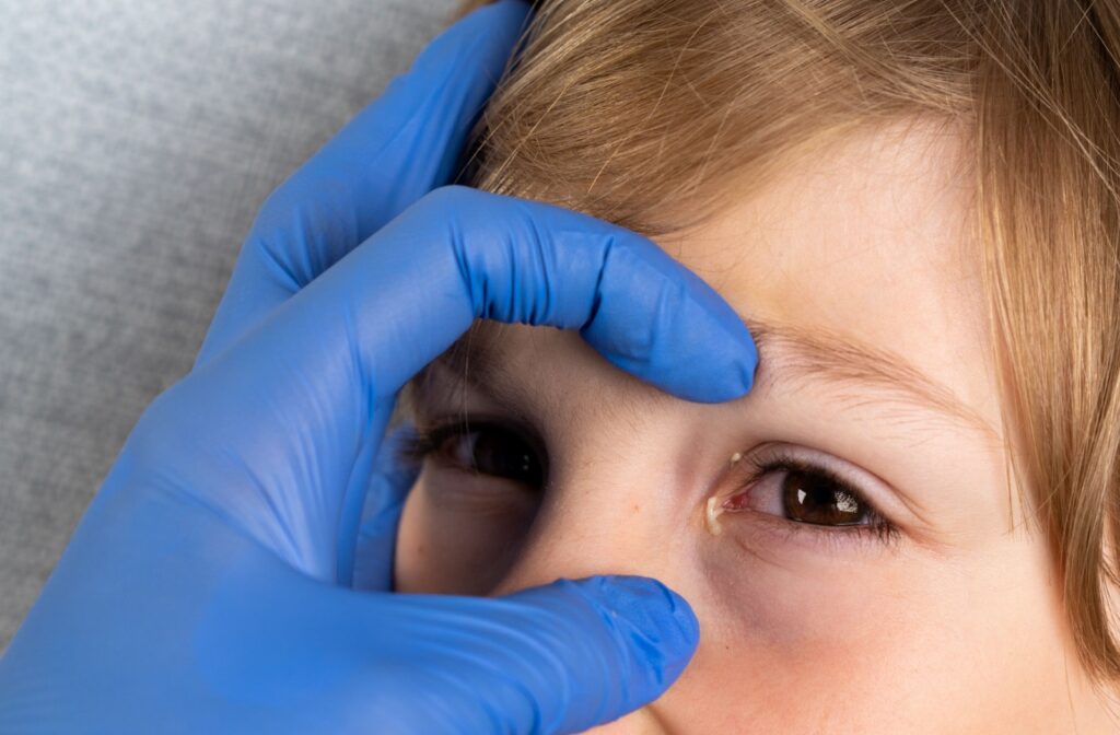 Close-up of a blue glove holding a child's face to show mucousy discharge coming out of eye.
