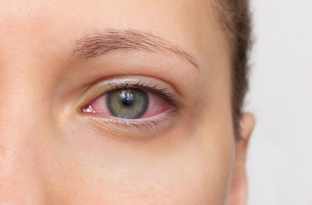 A close up of a red irritated eye caused by dry eye