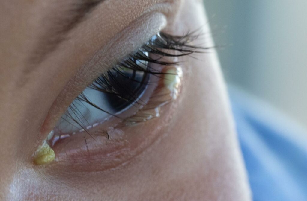 A close up of an eye with pus caused by blepharitis