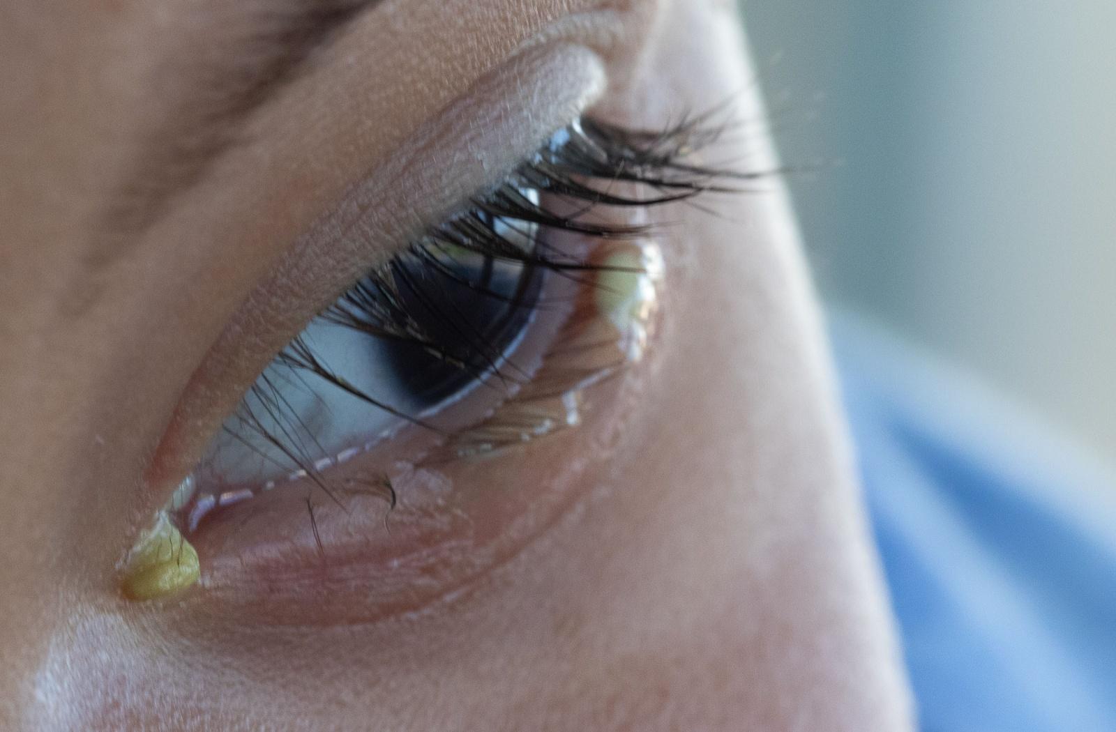 A close up of an eye with pus caused by blepharitis