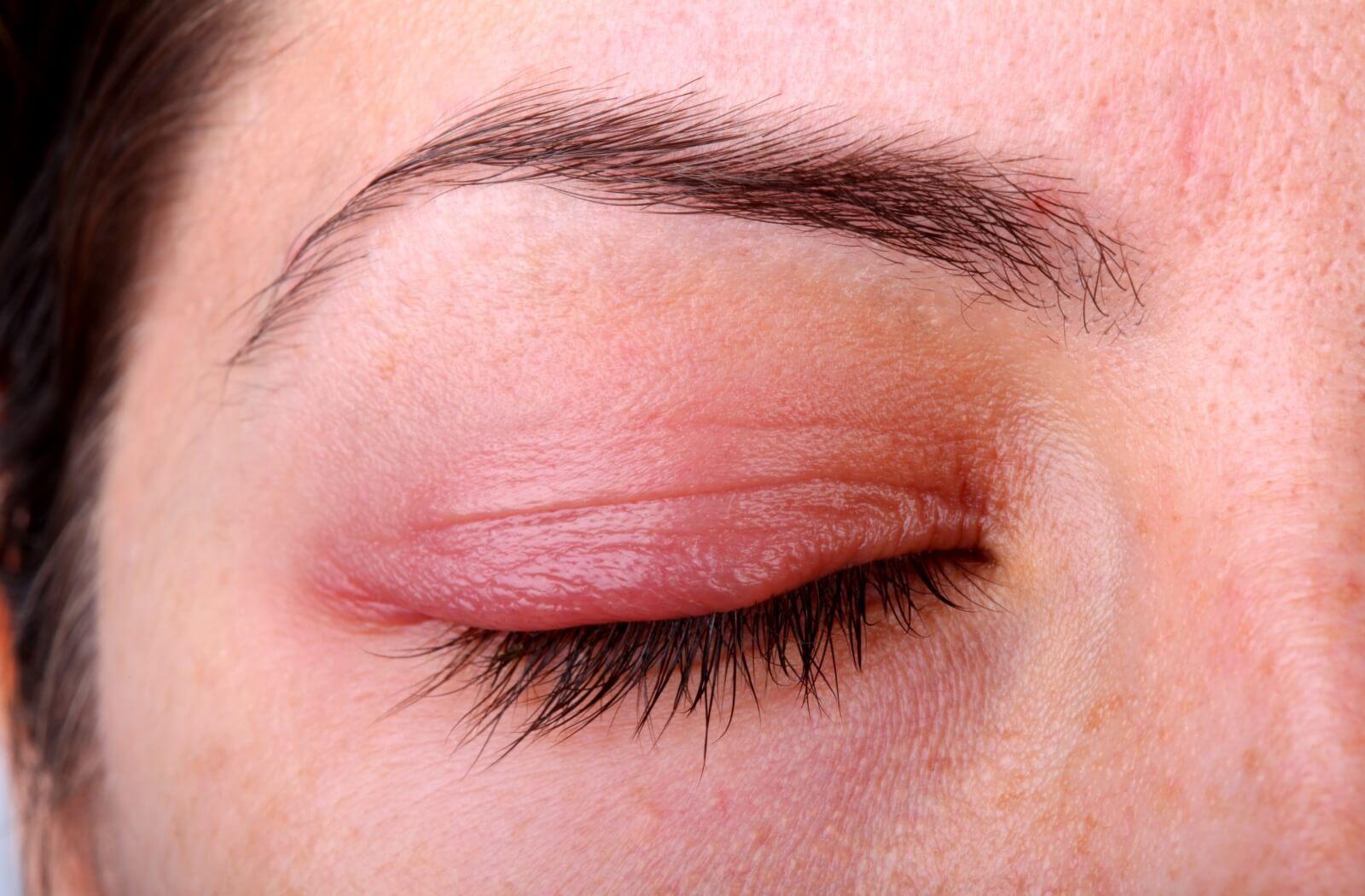 Close-up of a person's red, inflamed eye due to infection.